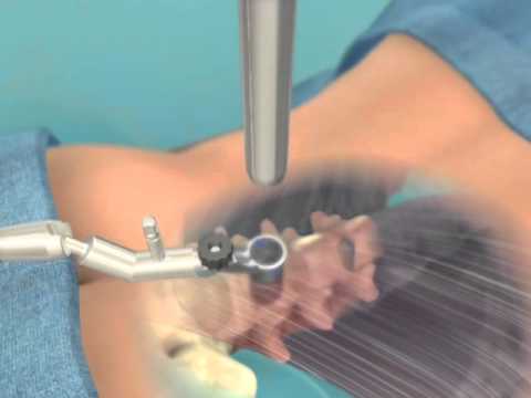 MET Rx Spine Surgery | Metrx Minimally Invasive Microdiscectomy